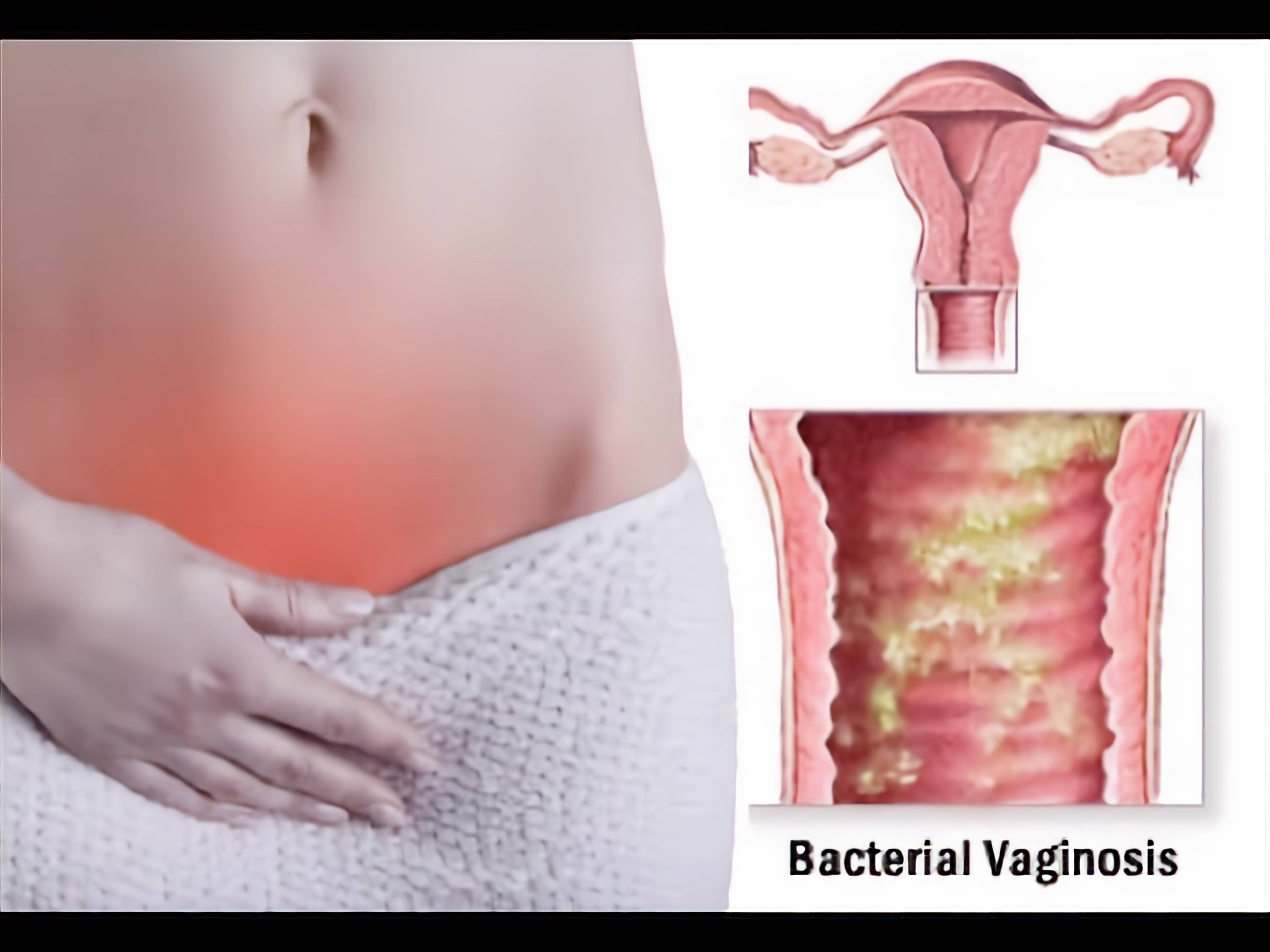 bacterial vaginosis no more reviews